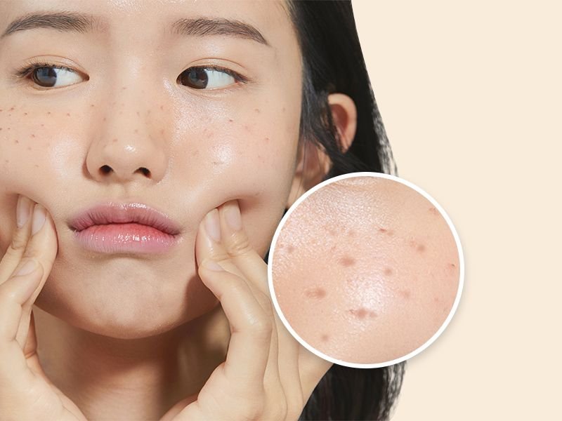 Pico Laser treatment at A.I. Skin Revolution BGC